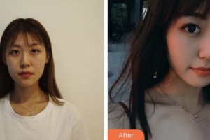 淮安光明眼科醫(yī)院張勝玉整形價(jià)格表附埋線(xiàn)雙眼皮案例展示