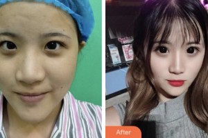 婁底美科醫(yī)療美容門診部（原婁底華美整形美容醫(yī)院）姜昌君整形價(jià)格表附切開雙眼皮案例展示