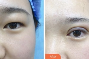 婁底市第一人民醫(yī)院燒傷整形外科牛方明整形價(jià)格表附眼部綜合案例展示