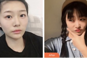 婁底希美醫(yī)療美容門診部代慶成整形價(jià)格表附激光去眼袋案例展示