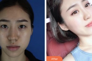 婁底市中心醫(yī)院整形美容科潘葵整形價(jià)格表附眼部綜合案例展示