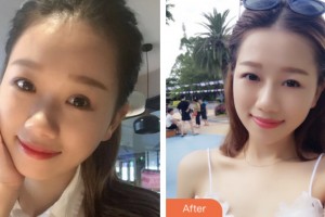 婁底愛思特醫(yī)療美容醫(yī)院張軍輝整形價(jià)格表附鼻部綜合案例展示