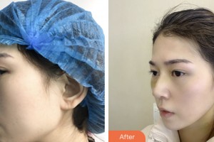 婁底市第一人民醫(yī)院燒傷整形外科邱建才整形價(jià)格表附鼻部綜合案例展示