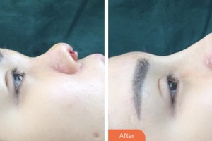 婁底市第一人民醫(yī)院燒傷整形外科曹毅整形價(jià)格表附鼻部綜合案例展示