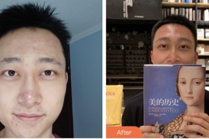 荊門市第一人民醫(yī)院醫(yī)學(xué)美容中心劉艷明整形價(jià)格表附種眉毛案例展示