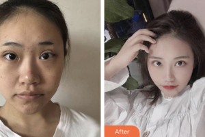 荊門市第一人民醫(yī)院醫(yī)學(xué)美容中心閔峰整形價(jià)格表附埋線提升案例展示