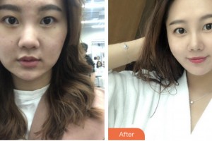 荊門中翰整形美容醫(yī)院劉俊整形價(jià)格表附超聲提拉案例展示