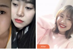 荊門市第一人民醫(yī)院醫(yī)學(xué)美容中心嚴(yán)加林整形價(jià)格表附牙齒矯正案例展示