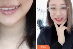 荊門劉永國醫(yī)療美容診所劉永國整形價(jià)格表附隱形托槽矯正案例展示