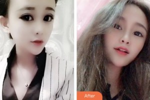 荊門亞貝特口腔醫(yī)院趙高峰整形價(jià)格表附美白劑美白牙齒案例展示