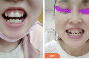 荊門小白兔口腔醫(yī)院趙小康整形價格表附超聲波潔牙案例展示