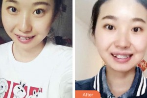 荊門小白兔口腔醫(yī)院杜成整形價格表附自鎖托槽矯正案例展示