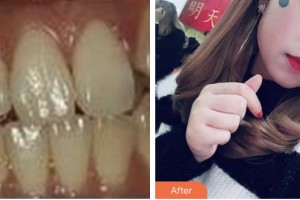 荊門小白兔口腔醫(yī)院王覓整形價格表附牙齒隱形矯正案例展示