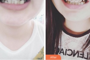 荊門小白兔口腔醫(yī)院張陽整形價格表附金屬托槽矯正例展示