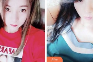 荊門小白兔口腔醫(yī)院徐小蔓整形價格表附超聲波潔牙案例展示