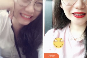 荊門市口腔醫(yī)院鄒廷前整形價格表附金屬托槽矯正案例展示