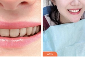 荊門市口腔醫(yī)院官瑩玉整形價格表附冷光美白案例展示