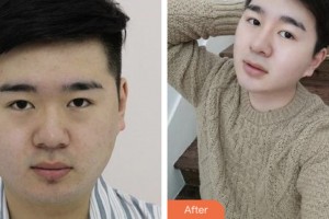 株洲藝佳醫(yī)療美容專科醫(yī)院李文軍整形價格表附假體隆鼻案例展示