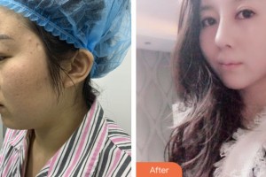 株洲中雅醫(yī)療美容門診部陳瑜整形價格表附耳軟骨復合隆鼻案例展示