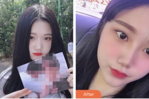 株洲藝佳醫(yī)療美容?？漆t(yī)院高謝輝整形價格表附耳軟骨復合隆鼻案例展示