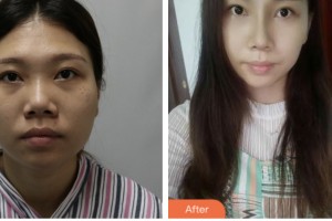 株洲嘉美醫(yī)療整形美容診所鄧曉林整形價格表附鼻部綜合案例展示