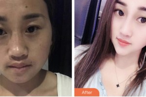 株洲市一醫(yī)院燒傷整形外科蘇開新整形價(jià)格表附鼻部綜合案例展示