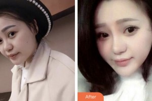 株洲華美整形醫(yī)美容醫(yī)院張涵整形價(jià)格表附鼻部綜合案例展示