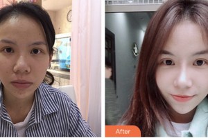 株洲市中心醫(yī)院整形美容科方玉蓉整形價格表附鼻修復案例展示