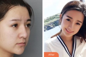 株洲市中心醫(yī)院整形美容科黃江山整形價格表附鼻部綜合案例展示