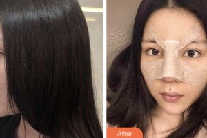 株洲市中心醫(yī)院整形美容科王志強整形價格表附墊鼻基底案例展示