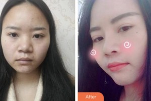 株洲愛思特醫(yī)療美容醫(yī)院張新成整形價格表附鼻部綜合案例展示