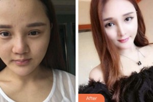 株洲宇芳姬醫(yī)療美容門診部李鶴整形價格表附鼻部綜合案例展示