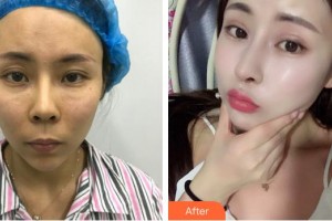 株洲雅美醫(yī)療美容門診部車旺整形價(jià)格表附鼻修復(fù)案例展示