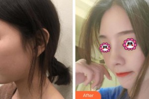 株洲愛(ài)爾眼科醫(yī)院尹泳紅整形價(jià)格表附肋軟骨隆鼻案例展示