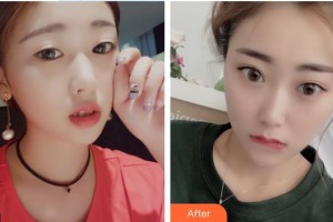 泰州泰勒美整形美容醫(yī)院張曉窗整形價(jià)格表附美容冠案例展示