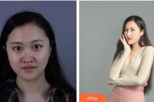 泰州第四人民醫(yī)院整形美容分院錢(qián)春華整形價(jià)格表附鼻部綜合案例展示