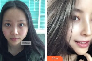 泰州麗都醫(yī)療美容醫(yī)院丁光攝整形價(jià)格表附肋軟骨隆鼻案例展示