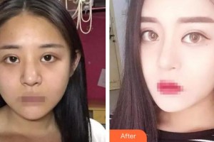 泰州麗都醫(yī)療美容醫(yī)院李鎮(zhèn)鎬整形價(jià)格表附鼻部綜合案例展示