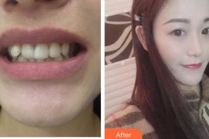 泰州麗都醫(yī)療美容醫(yī)院蔣自強整形價格表附牙齒隱形矯正案例展示