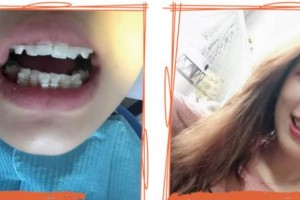 泰州市人民醫(yī)院燒傷整形科陳新龍整形價格表附隱形托槽矯正案例展示