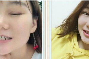 泰州麗都醫(yī)療美容醫(yī)院曾志威整形價格表附牙齒陶瓷矯正案例展示