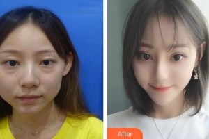 泰州麗都醫(yī)療美容醫(yī)院楊義整形價格表附美白貼片案例展示