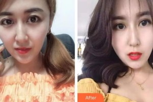 泰州愛爾眼科醫(yī)院葉楠整形價格表附激光去黑眼圈案例展示