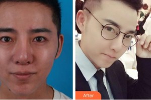 泰州愛(ài)爾眼科醫(yī)院郁素蘭整形價(jià)格表附內(nèi)切祛眼袋案例展示