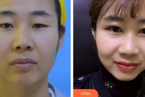 泰州北極星口腔門(mén)診部張海瀚整形價(jià)格表附隱形托槽矯正案例展示