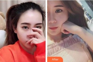 泰州玲瓏口腔門(mén)診部黃雨琴整形價(jià)格表附牙齒隱形矯正例展示