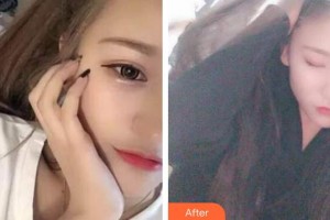 泰州拜博口腔醫(yī)院李文文整形價格表附冷光美白案例展示