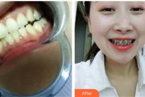 鎮(zhèn)江汪有國(guó)整形美容醫(yī)院汪有國(guó)整形價(jià)格表附牙齒陶瓷矯正案例展示