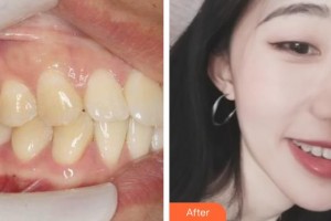 鎮(zhèn)江市第一人民醫(yī)院美容整形科徐斌整形價格表附牙齒隱形矯正案例展示