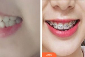 鎮(zhèn)江市第一人民醫(yī)院美容整形科嚴志新整形價格表附金屬托槽矯正案例展示